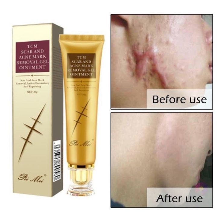 Gel Cosmétique Anti-Cicatrices